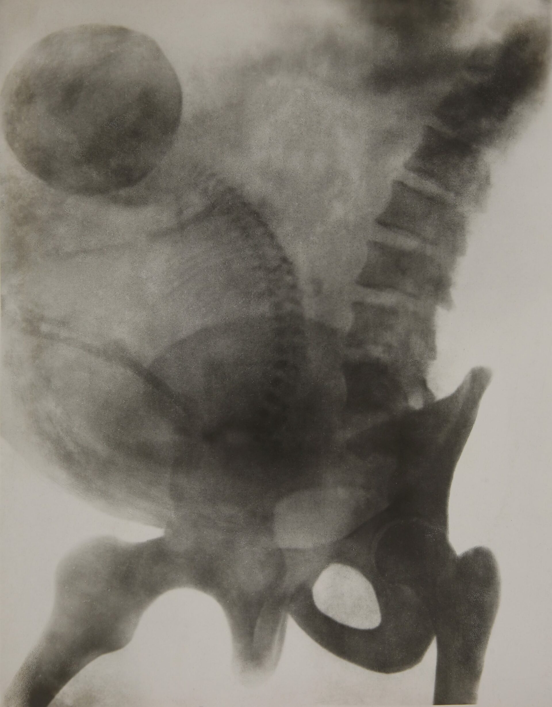 Kurt Warnekros, Tafel 3, Steisslage, in Schwangerschaft und Geburt im Röntgenbilde, 1917–21, Courtesy Skrein Photo Collection, © Städel Museum, Frankfurt am Main